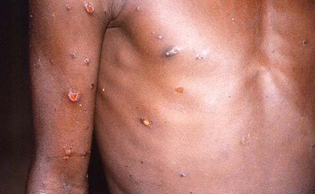 "What Seems To Be Happening Now...": WHO On Monkeypox Spread
