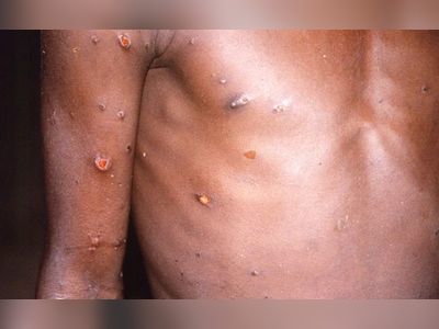 "What Seems To Be Happening Now...": WHO On Monkeypox Spread